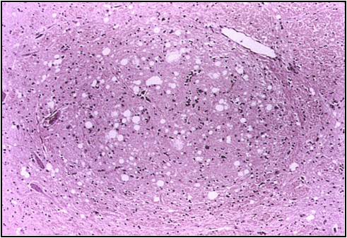 BSE 감염 소 뇌 조직 병변(조직병리학적 검사; H&E) 이미지