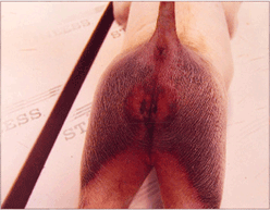 사진65) 전신성 대장균증에 감염된 자돈. 둔부 피부가 암적색으로 발적됨 이미지